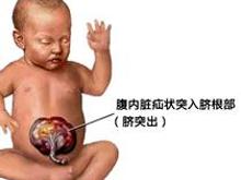 脐膨出-巨舌-巨体综合征