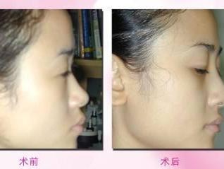 隆鼻后遗症 搜狗百科