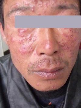 面部播散性粟粒状狼疮