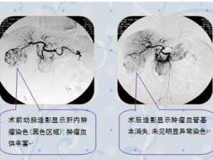 肝癌介入治疗