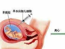 羊水穿刺检查 羊水穿刺检查