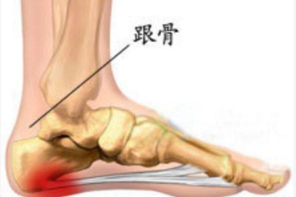 足跟骨刺 搜狗百科 足跟骨刺 搜狗百科