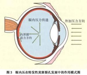 特发性黄斑裂孔