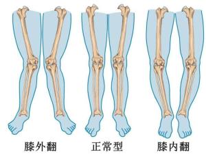 x型腿