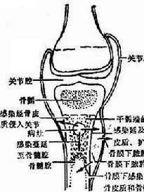 急性血源性骨髓炎