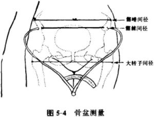 髂棘间距＜髂嵴间距＜大转子间距