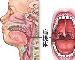 癌瘤多發生於扁桃體上極,常有淺表潰瘍,也可有浸潤,經扁桃體上窩及舌