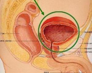 前列腺钙化灶