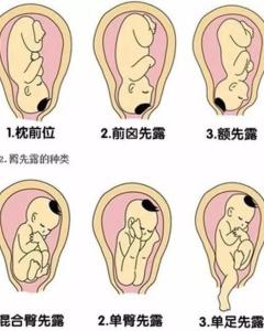 臀位听胎心的位置图图片
