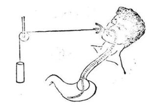 三腔二囊管 三腔二囊管