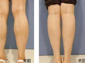 瘦腿针