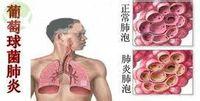 葡萄球菌肺炎