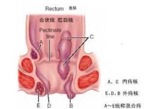 肛门脱出