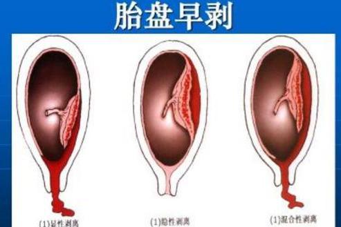 胎盘早剥 搜狗百科