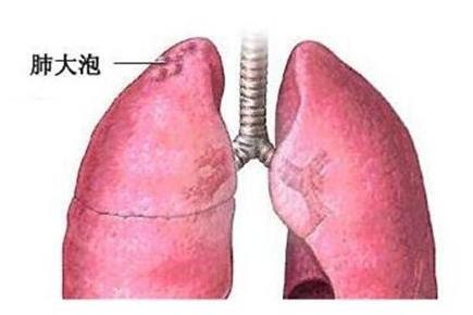 肺大泡 搜狗百科