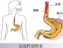 反流性食道炎
