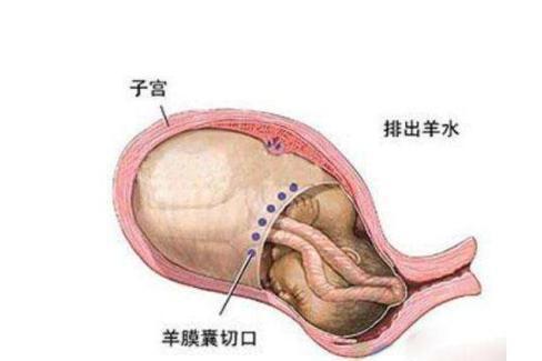 羊水栓塞 搜狗百科