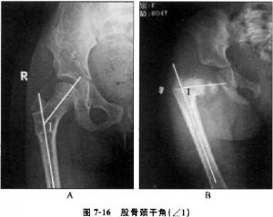 股骨颈干角小于90°为严重髋内翻