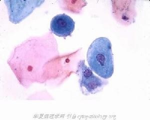 肠上皮化生