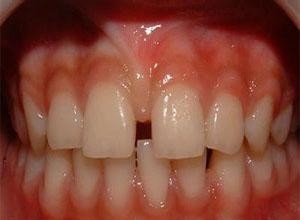 如不退缩且在牙床门之间附着过低,就会引起上门牙之间缝隙过宽