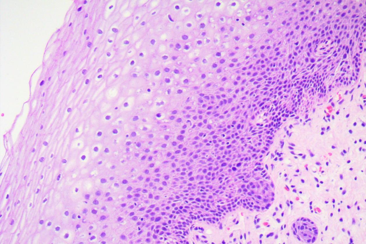 hpv16