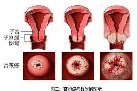 子宫癌 搜狗百科