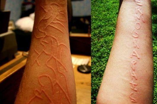 皮肤划痕症 搜狗百科