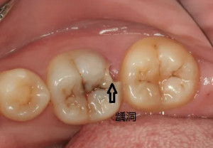 平滑面龋的病损形态是图片