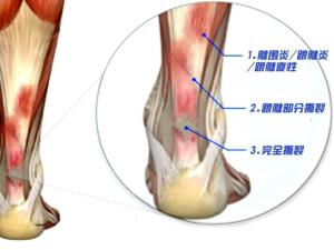 跟腱炎