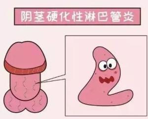 阴茎硬化性淋巴管炎是皮肤性病科,以阴茎皮下条索状肿块为特征,组织