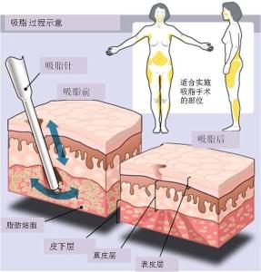 吸脂原理图示