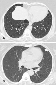 双肺大量随机分布大小不一类圆形结节血栓性钙化ct