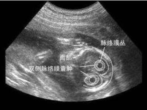 脉络丛囊肿