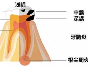 根尖周炎