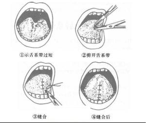 中文名稱舌繫帶過短矯正瘢痕體質者禁禁忌症適用舌繫帶過短者副作用