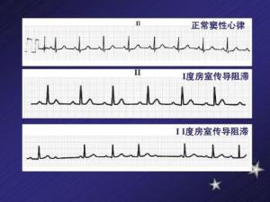 房室传导阻滞