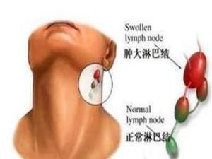 颌下淋巴结肿大压痛