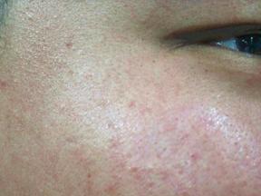 3,角质代谢缓慢毛孔堵塞皮肤粗糙细胞老化了,必然会干燥缺水,令表皮