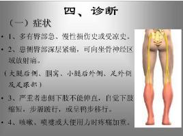 梨状肌综合征