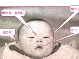 唐氏症胎儿