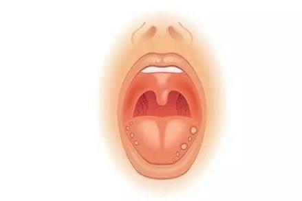 口腔溃疡 口腔疾病 搜狗百科 口腔溃疡 口腔疾病 搜狗百科