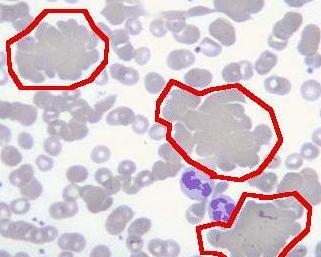 急性白血病是正细胞贫血吗 0