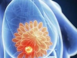 乳腺结节