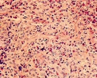 毛霉病(mucormycosis)是一种较少见而往往又是致命的条件性真菌感染