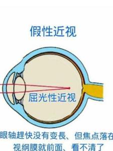 假性近视