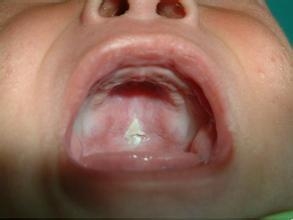 疱疹性口腔炎
