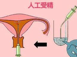人工受孕