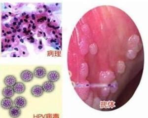 包皮尖锐湿疣