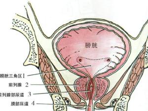 膀胱癌示意图图片