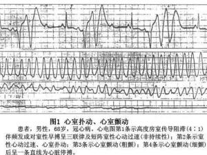 心室扑动与颤动